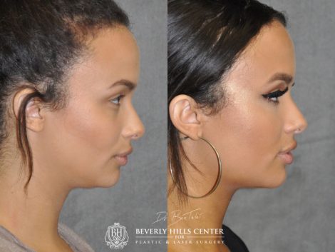 Neck MicroLiposuction with subtle UnderEye Refresh, Cheek Contour, Chin Projection, and Lip Enhancement - Right Side