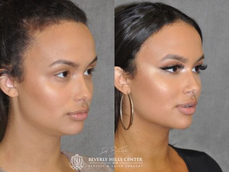 Neck MicroLiposuction with subtle UnderEye Refresh, Cheek Contour, Chin Projection, and Lip Enhancement - Right Side