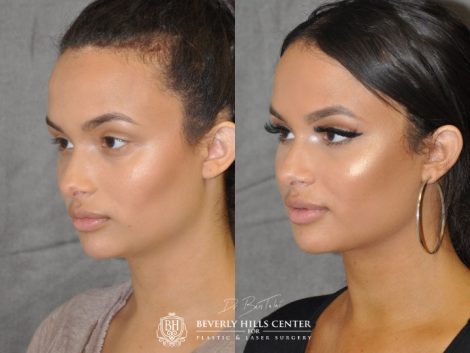 Neck MicroLiposuction with subtle UnderEye Refresh, Cheek Contour, Chin Projection, and Lip Enhancement - Left Side
