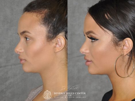 Neck MicroLiposuction with subtle UnderEye Refresh, Cheek Contour, Chin Projection, and Lip Enhancement - Left Side