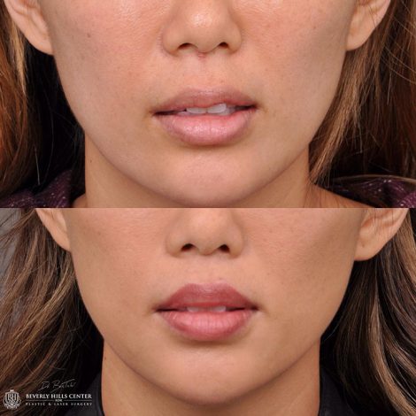 Modified Upper Lip Lift - Front