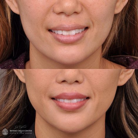 Modified Upper Lip Lift - Front