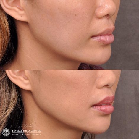 Modified Upper Lip Lift - Right Side