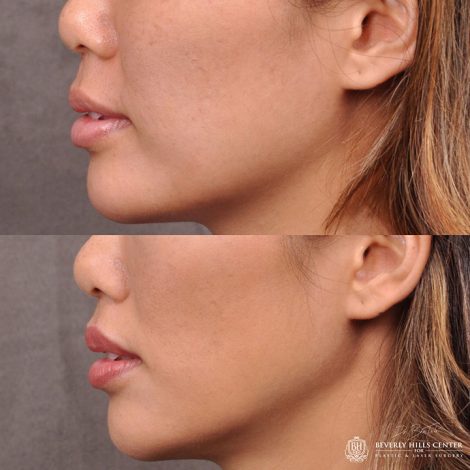 Modified Upper Lip Lift - Left Side