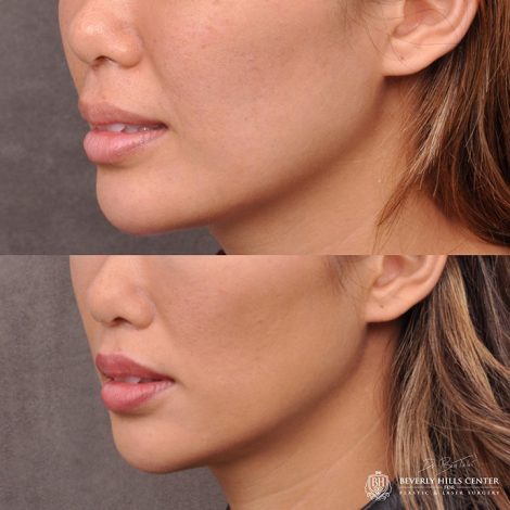 Modified Upper Lip Lift - Left Side
