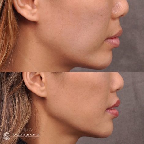 Modified Upper Lip Lift - Right Side