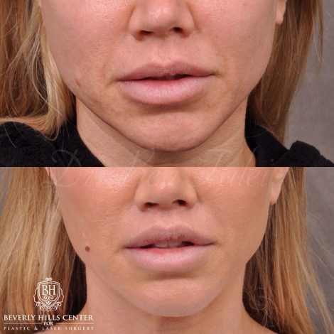 Modified Upper Lip Lift and Profound RF skin tightening - Front