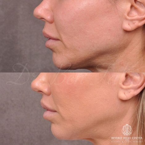 Modified Upper Lip Lift and Profound RF skin tightening - Left Side