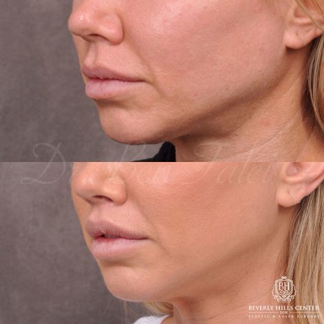 Modified Upper Lip Lift and Profound RF skin tightening - Left Side