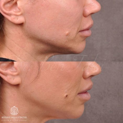 Modified Upper Lip Lift and Profound RF skin tightening - Right Side
