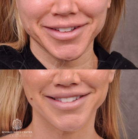 Modified Upper Lip Lift and Profound RF skin tightening - Front