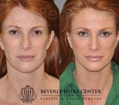 Patient Before and After Eye Area Treatment Beverly Hills CA