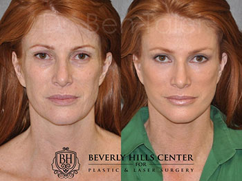 Blepharoplasty in Turkey  Medical Center Turkey