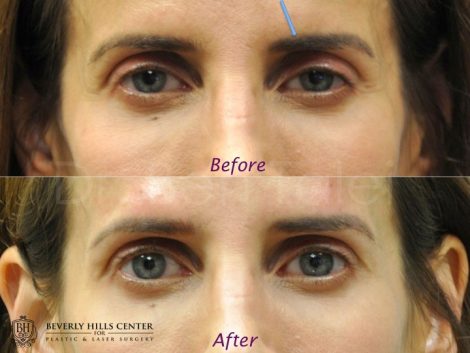Beverly Hills Center Female Patient Before and After Brow Filler