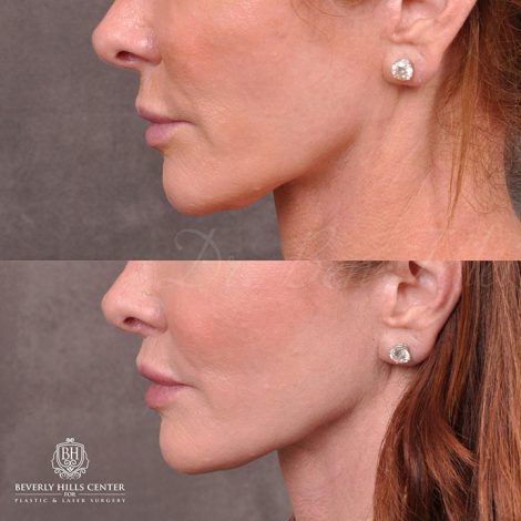 Beverly Hills Center Female Patient Before and After Modified Upper lip lift and Profound RF skin tightening