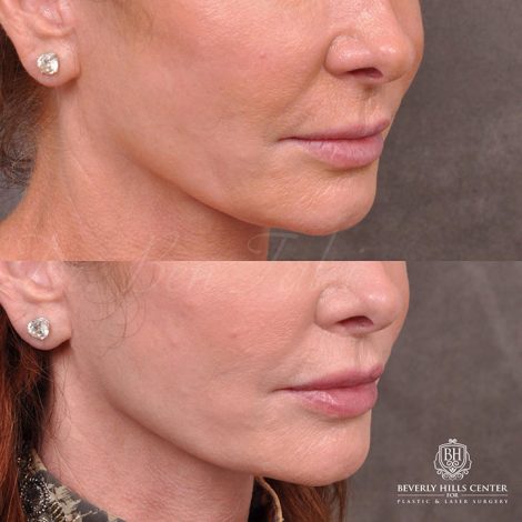 Beverly Hills Center Female Patient Before and After Modified Upper lip lift and Profound RF skin tightening
