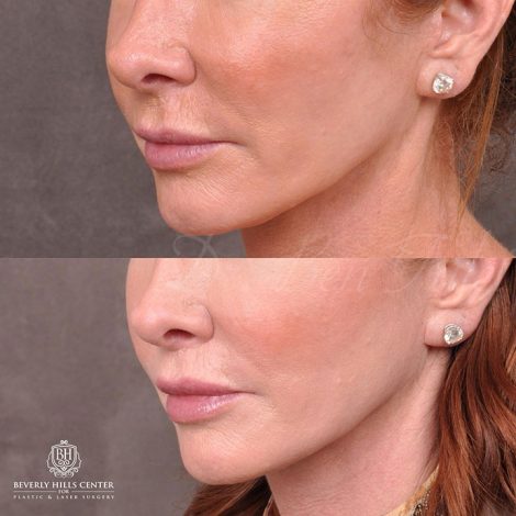Beverly Hills Center Female Patient Before and After Modified Upper lip lift and Profound RF skin tightening
