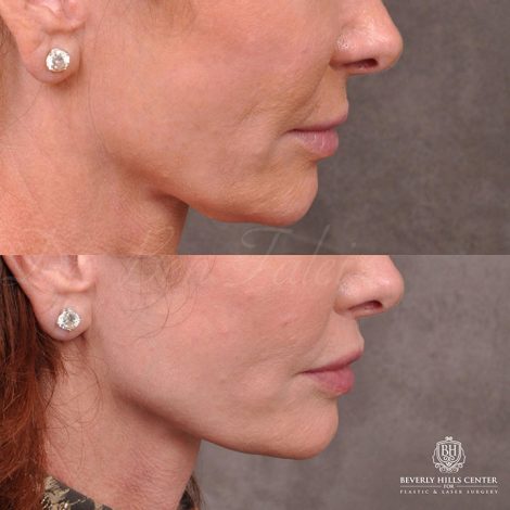 Beverly Hills Center Female Patient Before and After Modified Upper lip lift and Profound RF skin tightening