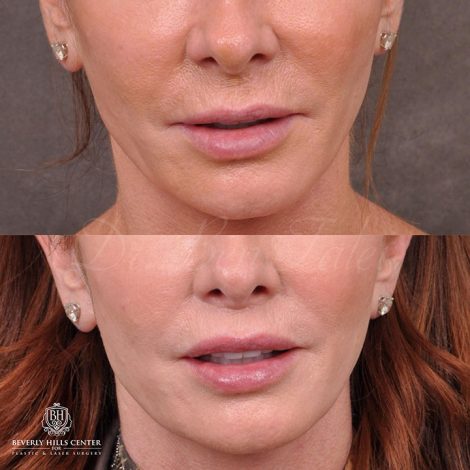 Beverly Hills Center Female Patient Before and After Modified Upper lip lift and Profound RF skin tightening