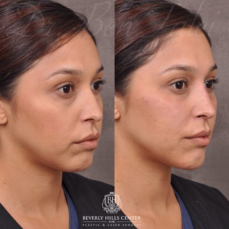 Beverly Hills Center Female Patient Before and After Facial Fillers Procedure