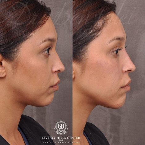 Beverly Hills Center Female Patient Before and After Facial Fillers Procedure