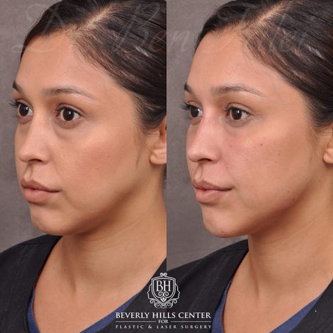 Beverly Hills Center Female Patient Before and After Facial Fillers Procedure