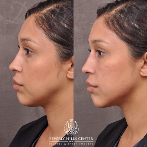 Beverly Hills Center Female Patient Before and After Facial Fillers Procedure
