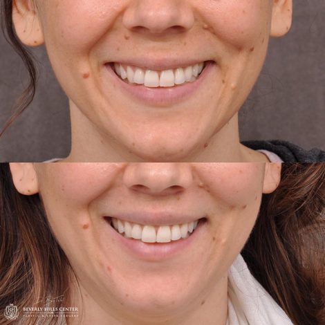 Modified Upper Lip Lift - Front