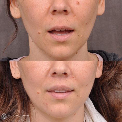 Modified Upper Lip Lift - Front