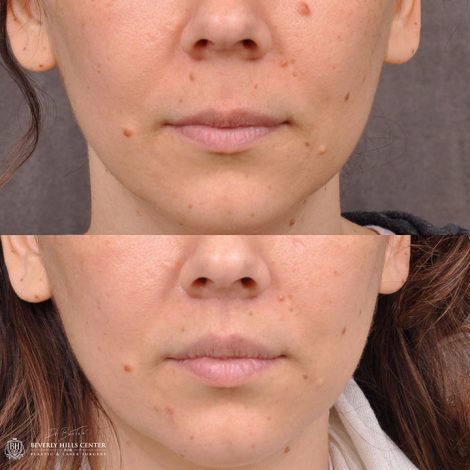 Modified Upper Lip Lift - Front