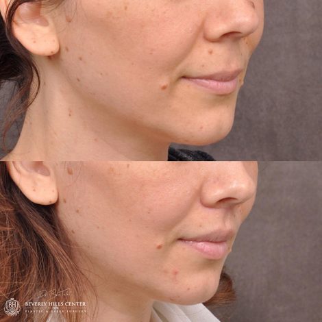 Modified Upper Lip Lift - Right Side