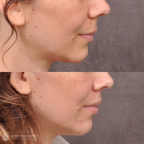Modified Upper Lip Lift - Right Side