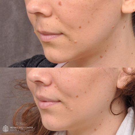Modified Upper Lip Lift - Left Side
