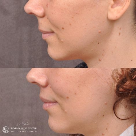 Modified Upper Lip Lift - Left Side