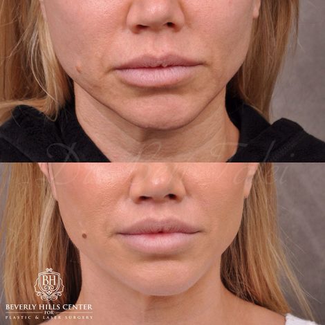 Beverly Hills Center Female Patient Before and After Modified Upper Lip Lift and Profound RF skin tightening