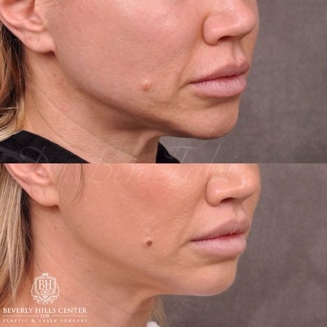 Beverly Hills Center Female Patient Before and After Modified Upper Lip Lift and Profound RF skin tightening