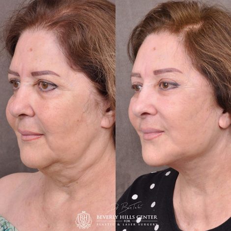 Revision Auralyft with Mini Brow Lift and Upper blepharoplasty