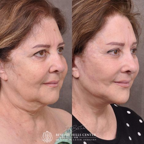 Revision Auralyft with Mini Brow Lift and Upper blepharoplasty