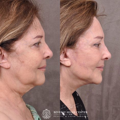 Revision Auralyft with Mini Brow Lift and Upper blepharoplasty