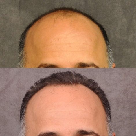 Frank A before and after the hair translplant procedure