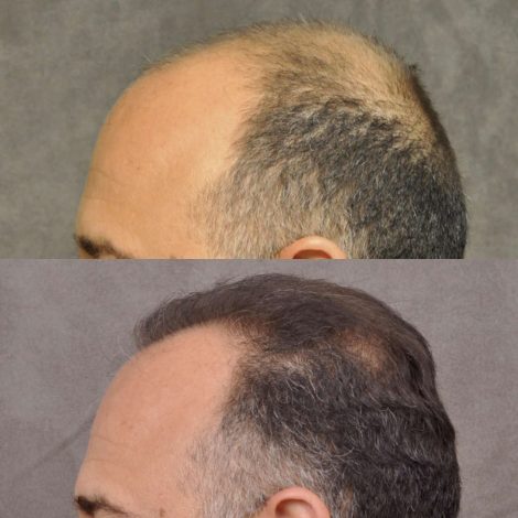 Frank A before and after the hair translplant procedure