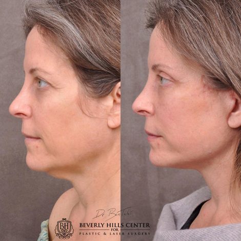 Auralyft, Mini Browlift, Upper Blepharoplasty - Left Side