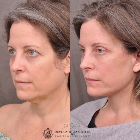 Auralyft, Mini Browlift, Upper Blepharoplasty - Left Side