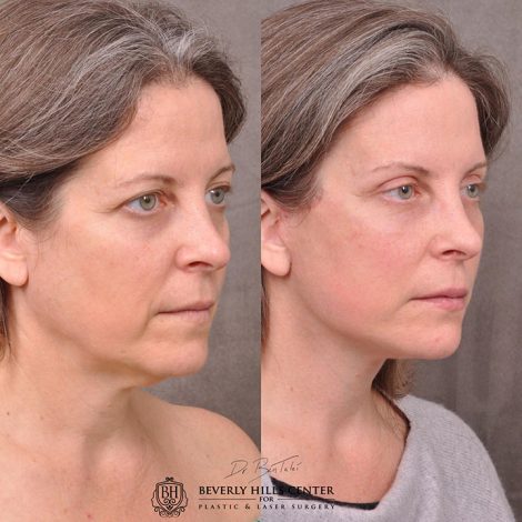 Auralyft, Mini Browlift, Upper Blepharoplasty - Right Side