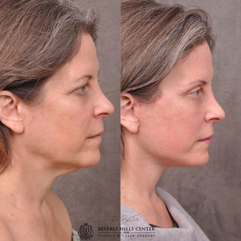 Auralyft, Mini Browlift, Upper Blepharoplasty - Right Side