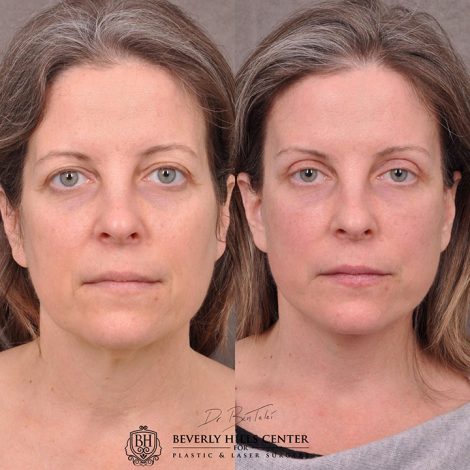 Auralyft, Mini Browlift, Upper Blepharoplasty - Front