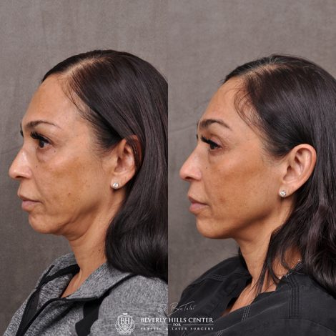 Beverly Hills Center Female Patient Before and After Profound RF Treatment