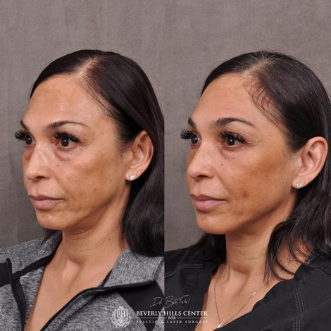 Beverly Hills Center Female Patient Before and After Profound RF Treatment