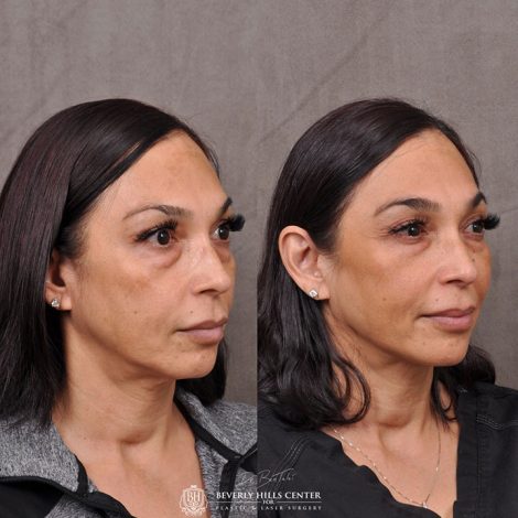 Beverly Hills Center Female Patient Before and After Profound RF Treatment