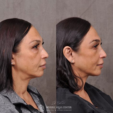 Beverly Hills Center Female Patient Before and After Profound RF Treatment